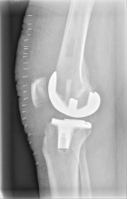 Röntgenbild nach OP von seitlich